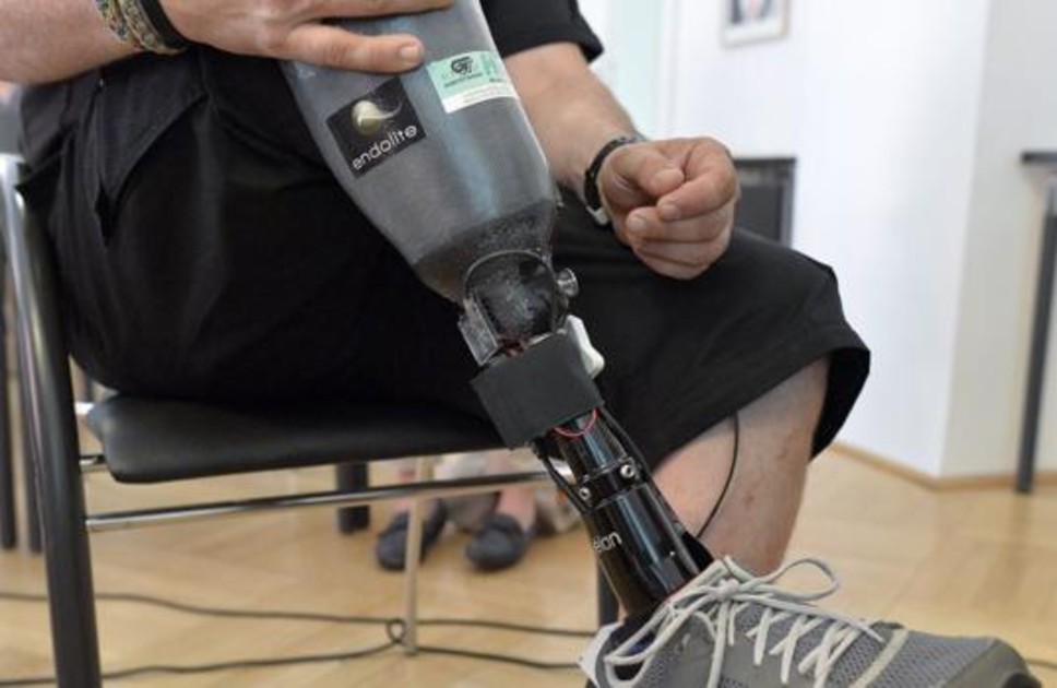 Urgen prótesis de pierna para pacientes en Venezuela